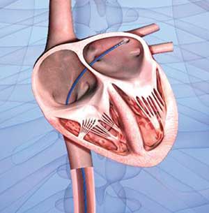Traced Back to the Watch - Cardiac catheter inserted into the heart