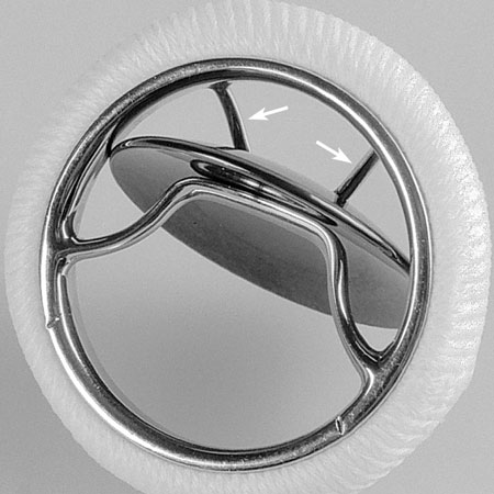 Safety First? - The Bjork-Shiley synthetic heart valve