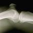 X Ray Of Joint