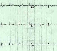 EKG